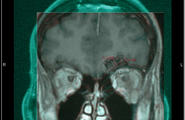 从误诊到医学小奇迹，用3D打印帮妻子治疗脑瘤图2
