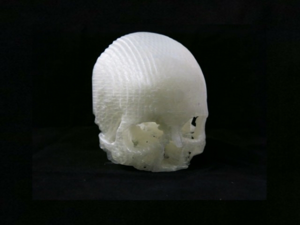 从误诊到医学小奇迹,用3D打印帮妻子治疗脑瘤图3